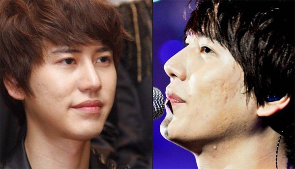 Nam ca sĩ Kyuhyun nhóm Super Junior luôn cởi mở khi đề cập tới làn da mụn của mình, thậm chí anh còn tự trào là da của anh tệ thứ hai sau nam ca sĩ Danny Ahn nhóm g.o.d. Kyuhyun là một trong 10 sao hàn khổ sở vì mụn.